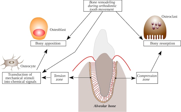 Vector remodelación ósea durante el movimiento dental ortodóncico