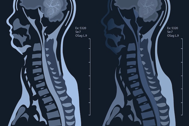 Vector resonancia magnética de la columna cervical, sagital (mri de la columna cervical) mostrando