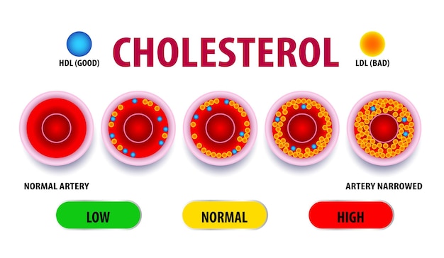 Riesgo para la salud de la arteria HDL y LDL en la arteria Prueba de colestano