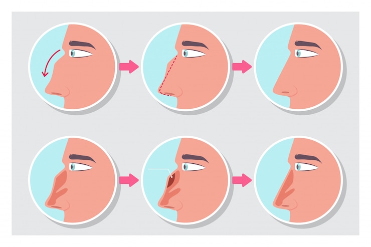 Vector rinoplastia antes y después de la infografía del procedimiento.