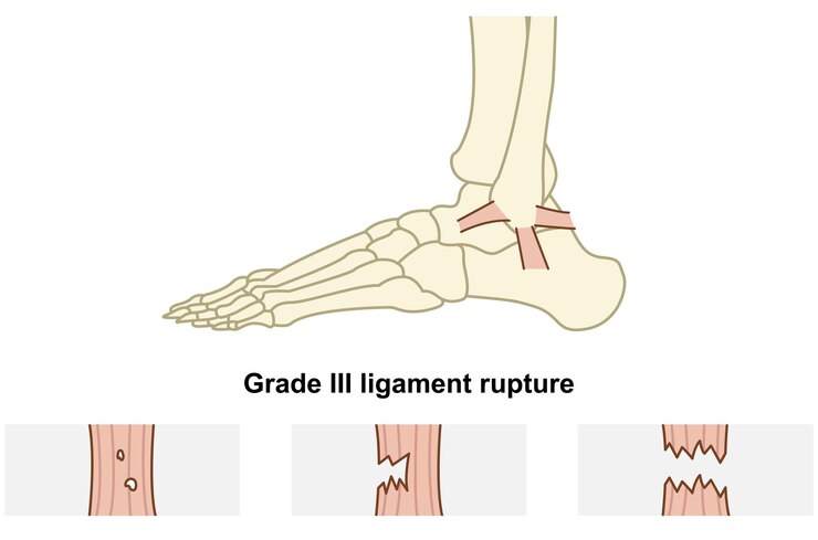 Vector ruptura de los ligamentos del tobillo y diferentes situaciones de lesión muscular ilustración plana