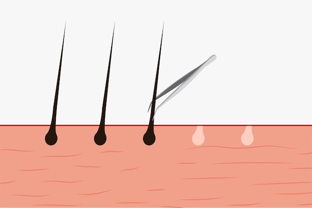 Vector sacar el vello corporal con una pinza vector usar una pinza para sacar el vello corporal de la piel ilustración del vector de piel con vello y una pinza concepto de depilación de la piel