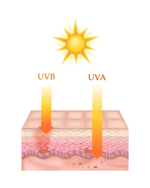 Sección transversal realista de las capas de piel humana afectadas por la ilustración vectorial de los rayos solares uva y uva