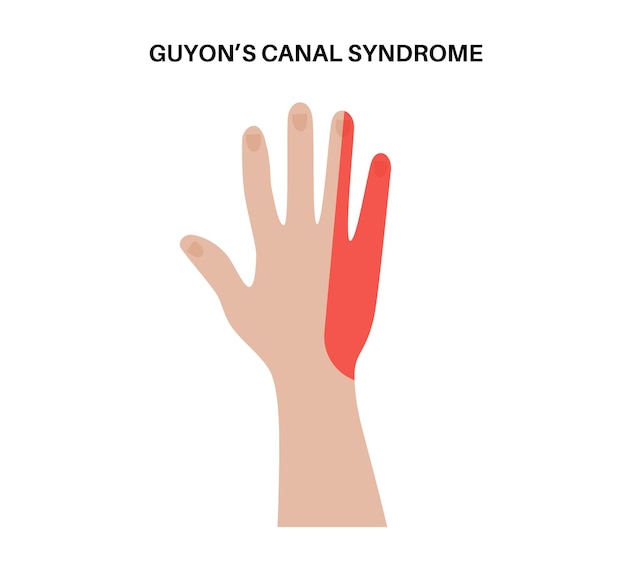 Vector síndrome del canal de guyon