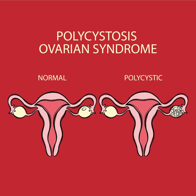 Vector síndrome de ovario poliquístico vs aparato reproductivo normal