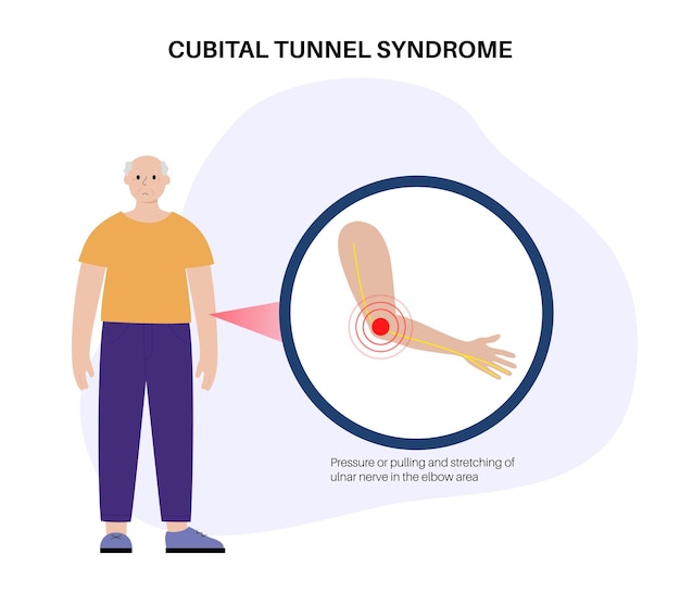 Vector síndrome del túnel cubital