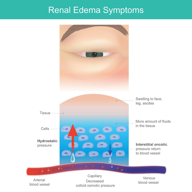 Vector síntomas del edema renal