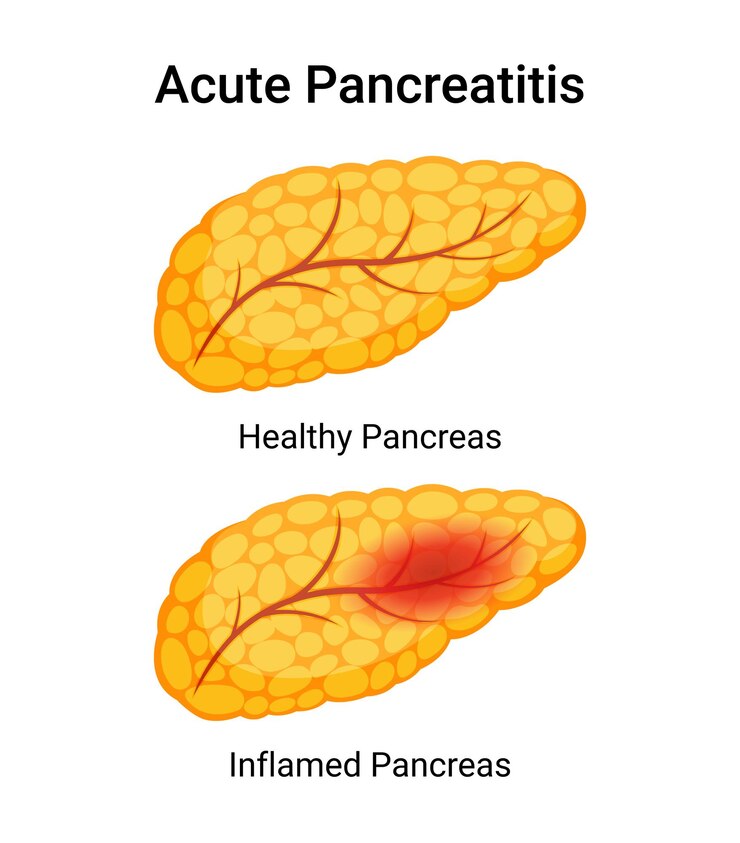 Vector síntomas de la pancreatitis aguda páncreas sano e inflamado