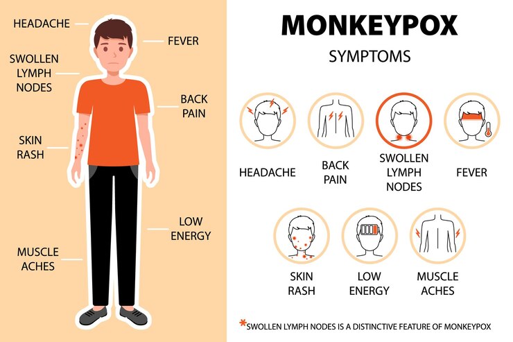 Vector síntomas del virus de la viruela del mono infografía con el hombre dolor de cabeza dolor de espalda ganglios linfáticos inflamados fiebre erupción cutánea, etc. dolor de cabeza dolor de espalda, etc. nuevos casos de brotes en europa y ee. uu.