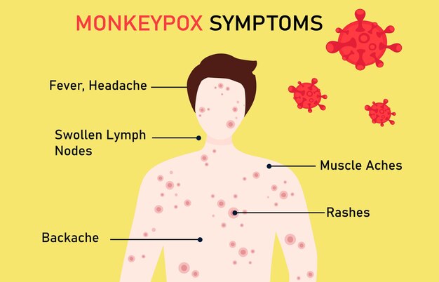 Vector síntomas del virus de la viruela del mono paciente con síntomas de fiebre del virus de la viruela del mono dolor de cabeza dolor de espalda