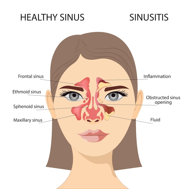 Vector sinusitis del rostro femenino con inflamación de la membrana mucosa del seno paranasal y frontal
