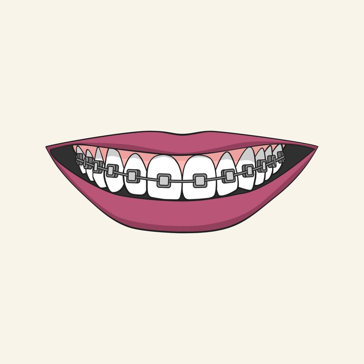 Vector sonriendo boca femenina con dientes sanos y frenillos.