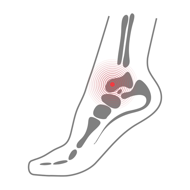 Suela del pie con huesos Biomecánica Calzado Zapato Salud médica Masaje Spa Acupuntura Dolor Concepto