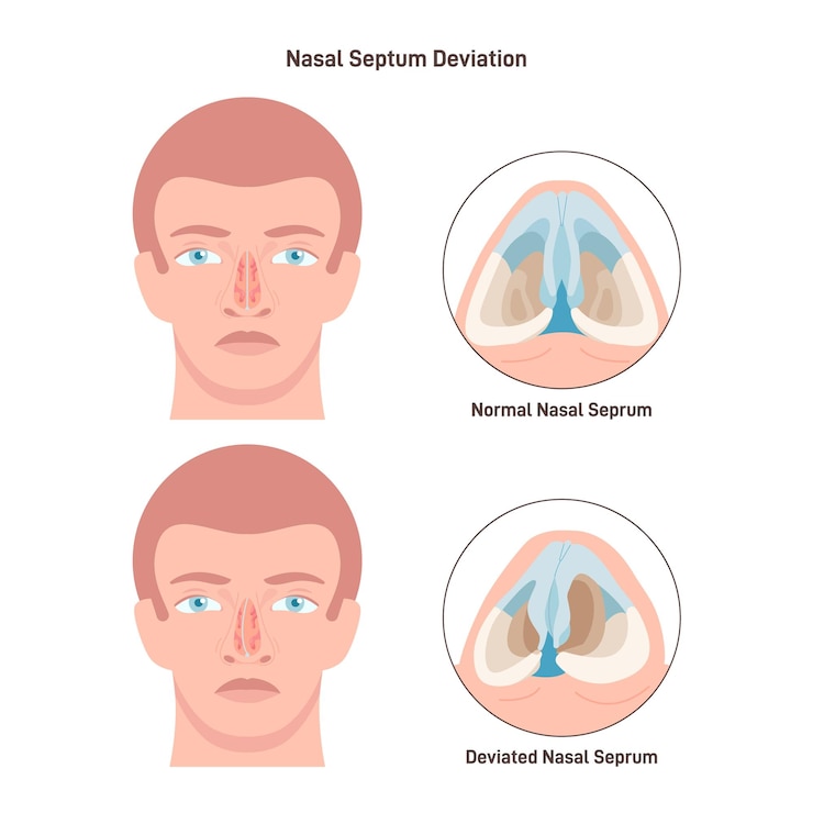 Vector tabique nasal desviado y normal condición médica de torcido