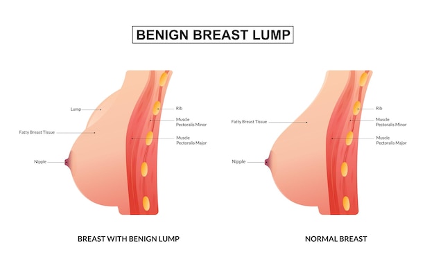 Vector tabla de educación médica de bulto mamario benigno