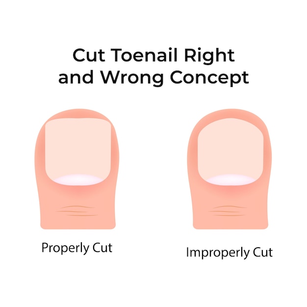 Técnicas adecuadas e inadecuadas para cortar las uñas de los pies Ilustración vectorial
