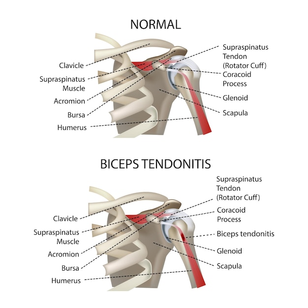 Vector tendinitis del bíceps, articulación del hombro, ilustración vectorial realista