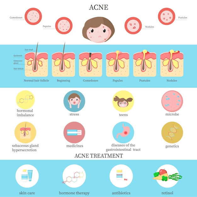 Tipos de acné causas y tratamiento infografía vector ilustración plana