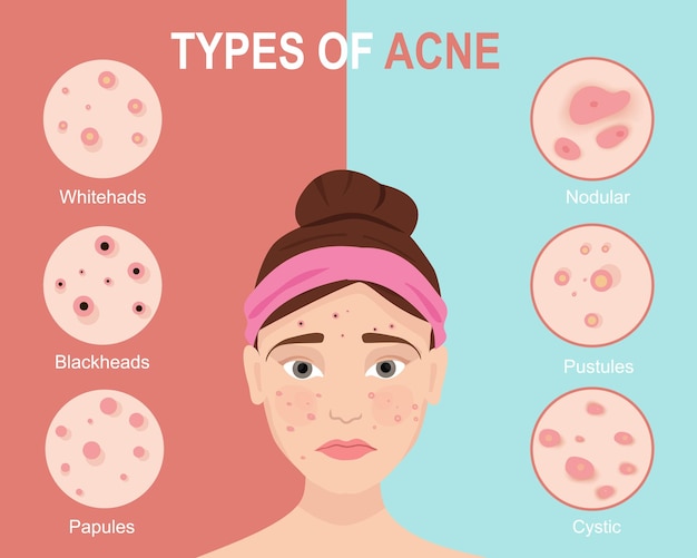 Vector tipos de acné problemas de la piel