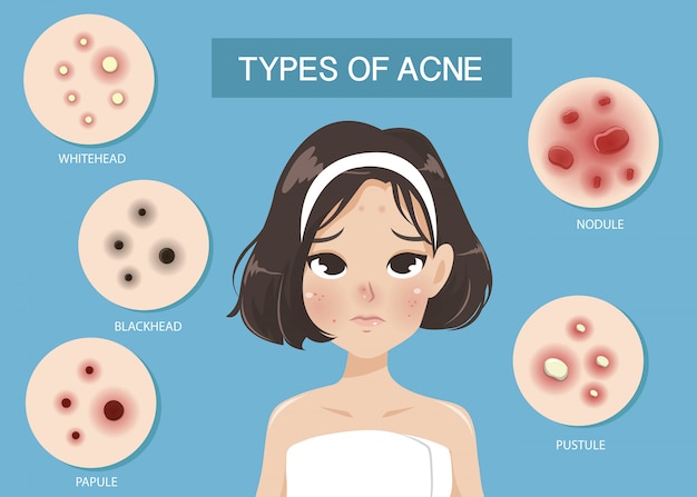 Vector tipos de acne