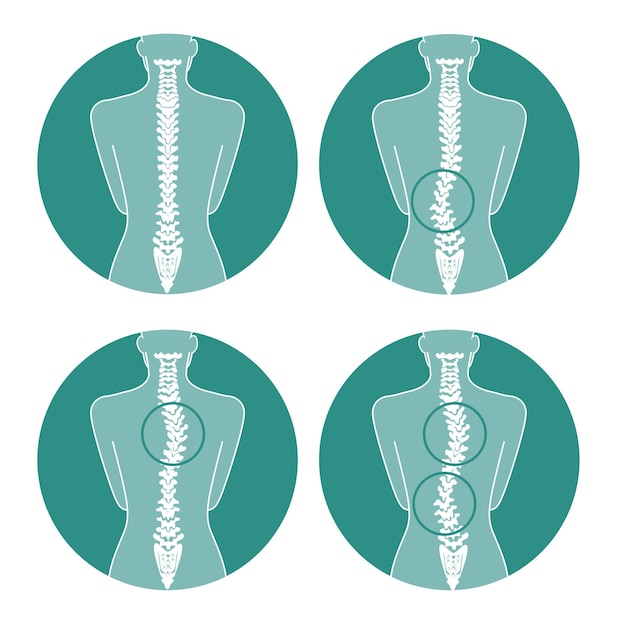 Vector tipos de anatomía de la escoliosis