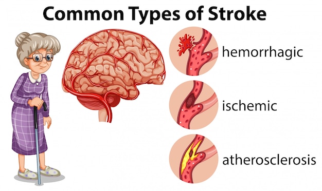 Tipos comunes de apoplejía