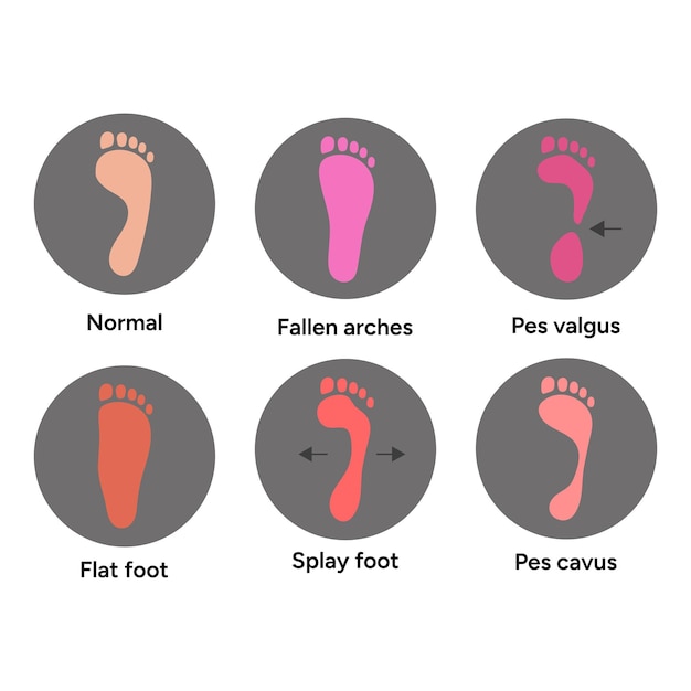Tipos de deformidad del pie pie caído pie plano pie pes valgus pes carvus pie extendido
