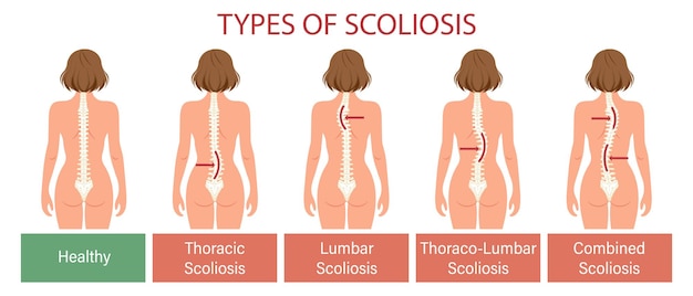 Tipos de escoliosis Enfermedad de la columna Infografías pancarta con escoliosis humana de la columna Salud