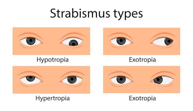 Tipos de estrabismo. Hipotropía, hipertropía, exotropía, esotropía. estilo de dibujos animados
