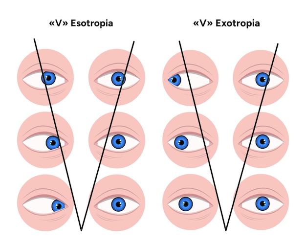 Tipos de estrabismo v esotropía y v exotropía