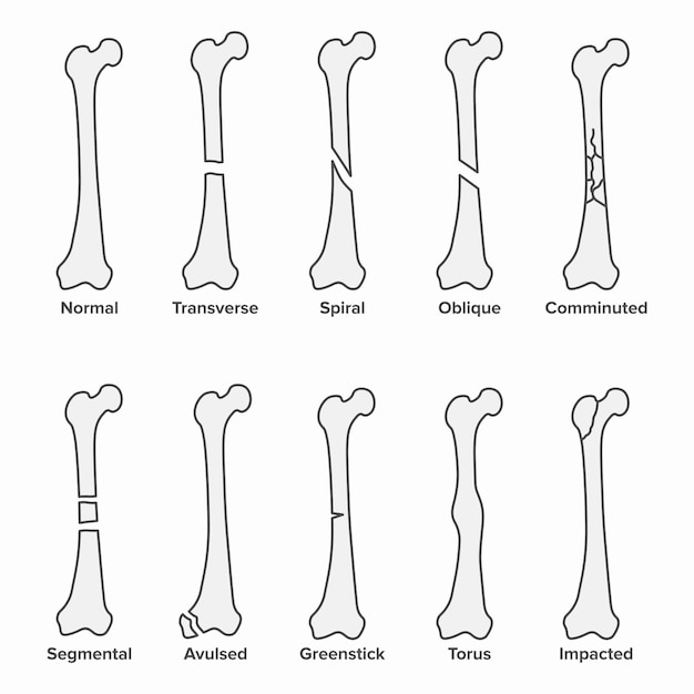 Vector tipos de fracturas, huesos rotos