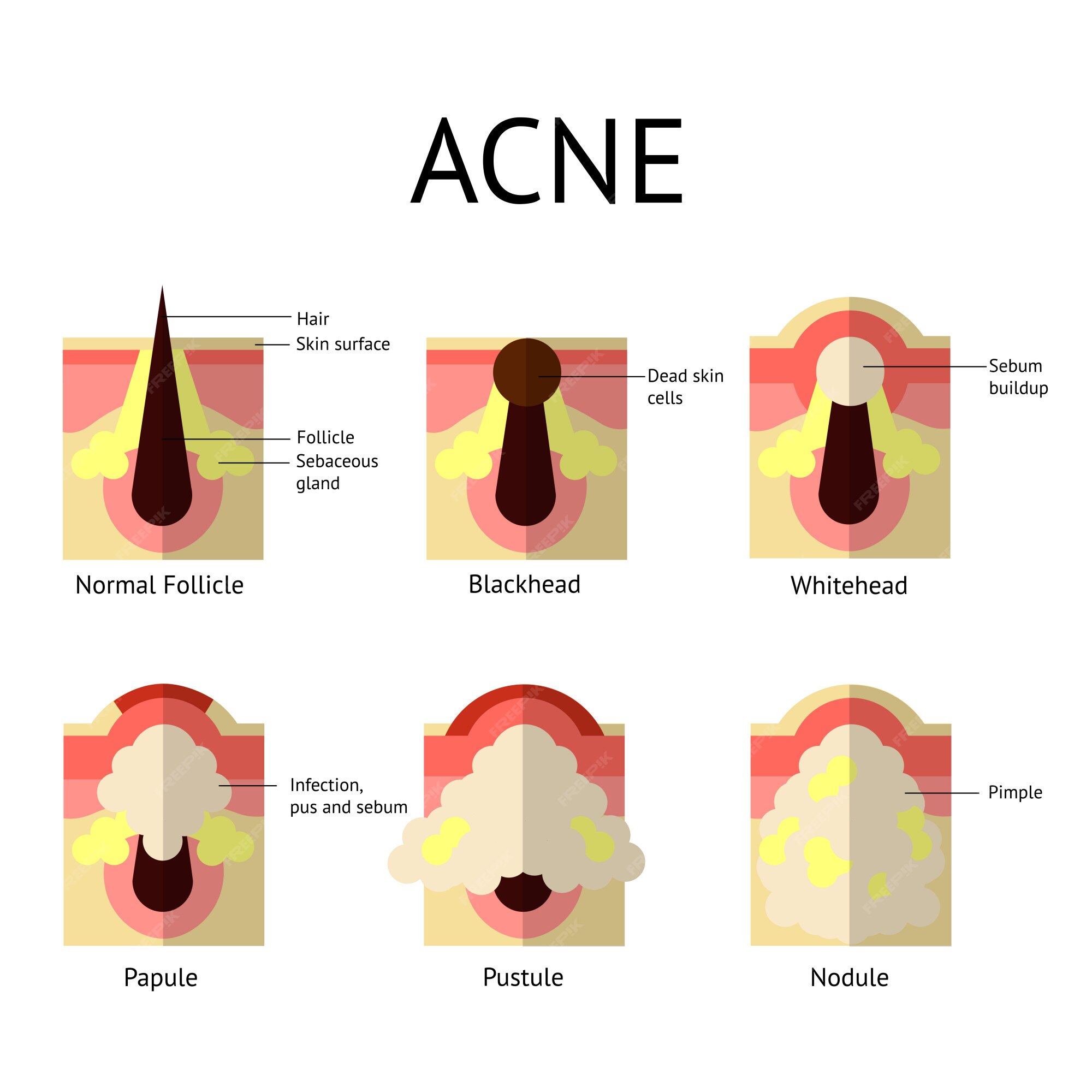 Tipos de de acné. piel sana, espinillas espinillas, pápulas y pústulas en estilo plano. | Vector Premium