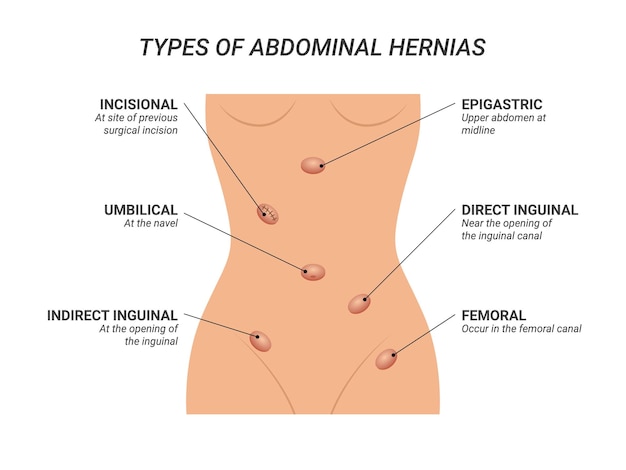 Tipos de ilustración de hernias abdominales sobre fondo aislado