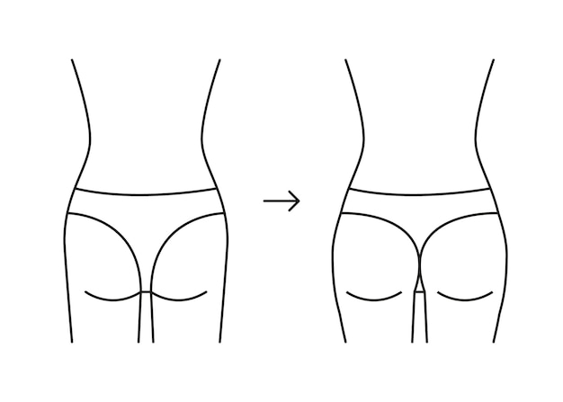 Tipos de línea trasera de glúteos con forma de mujer a tope. Aumento de glúteos remodelados desde plano en botín completo