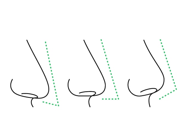 Vector tipos de narices corrección ángulo de forma nasal rinoplastia nariz chata nariz recta hacia abajo