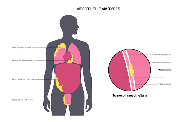 Vector tipos de tumores de mesotelioma