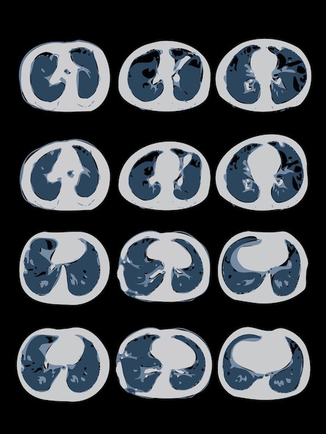 Tomografía computarizada de los pulmones de covid19