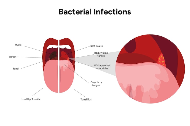 Vector tonsilitis por infección bacteriana