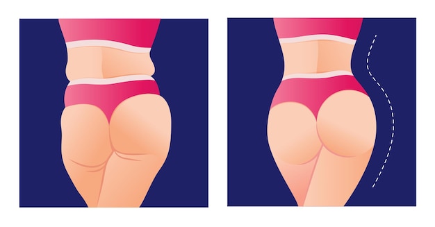 Transformación de grasa para adaptarse al cuerpo de la mujer antes y después de la dieta pérdida de peso