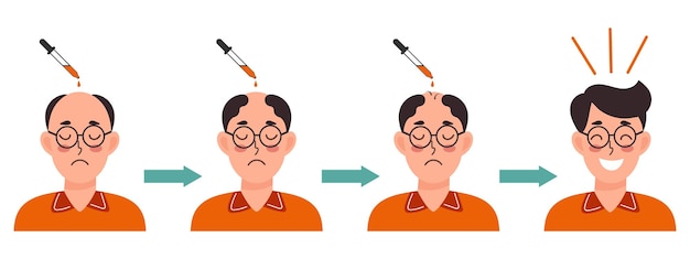 Trasplante de cabello humano y tratamiento de la calvicie Hombre antes y después del tratamiento del cabello