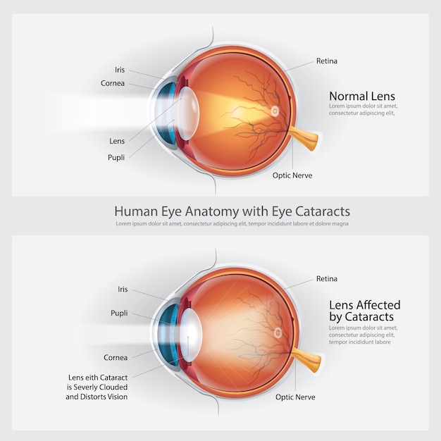 Trastorno de la visión de las cataratas y anatomía normal de la visión ocular