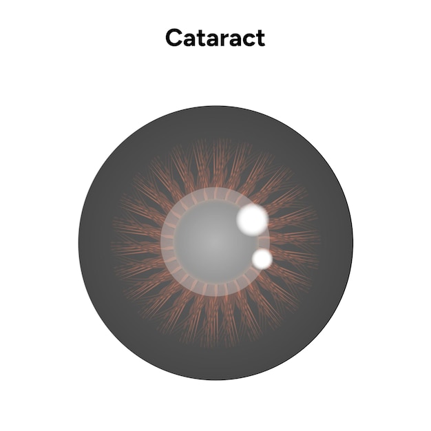 Trastorno de la visión por cataratas con ojo marrón
