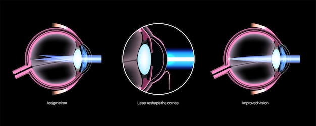 Tratamiento del astigmatismo ocular