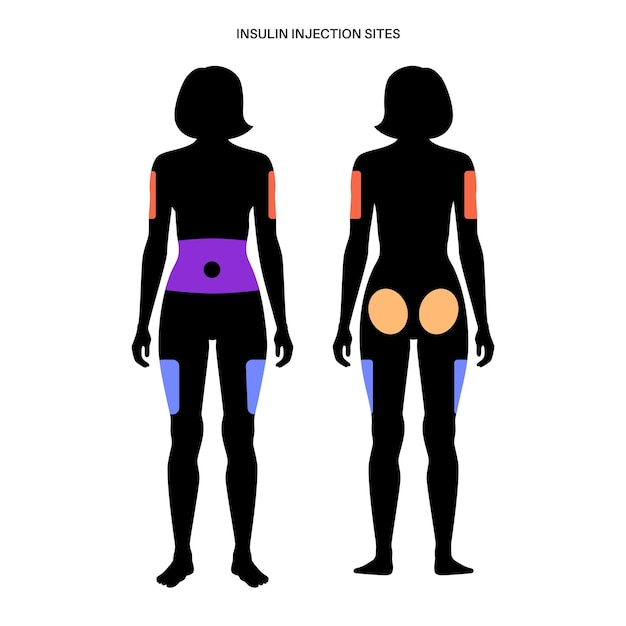 Tratamiento de la diabetes sitios de inyección de insulina en el vector plano del cuerpo femenino adulto humano