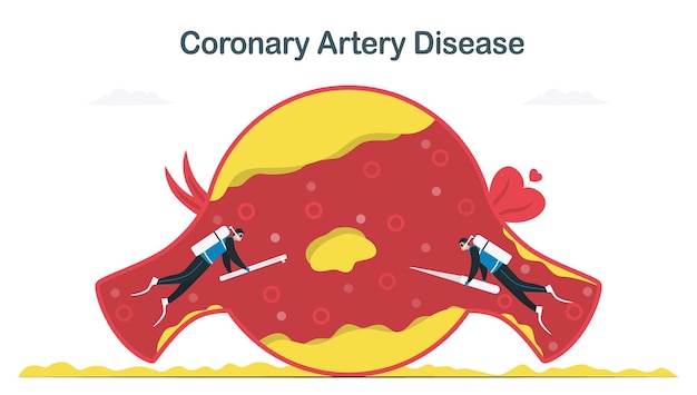 Tratamiento de la enfermedad de las arterias coronarias causada por la aterosclerosis. Más colesterol y depósitos de grasa en los vasos sanguíneos. Ilustración de vector de cardiología aislada sobre fondo blanco.