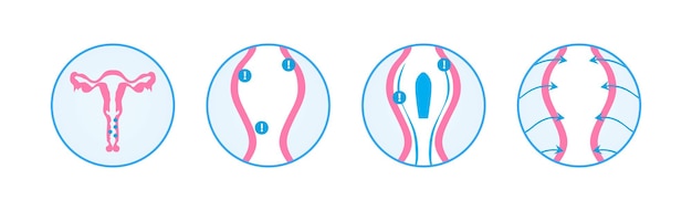 Tratamiento de infografías ginecológicas de los supositorios de vaginitis.