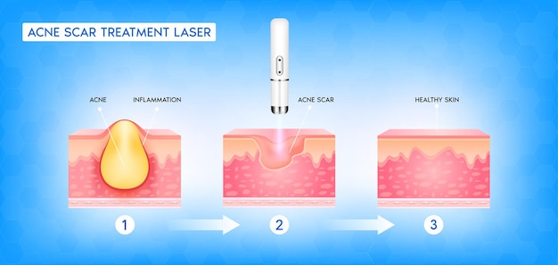 Tratamiento láser vascular de cicatriz de acné inflamación asociada a espinillas