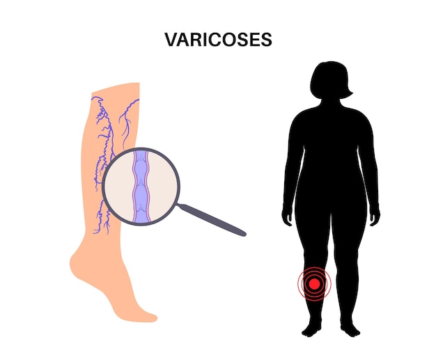 Vector tratamiento de venas varicosas