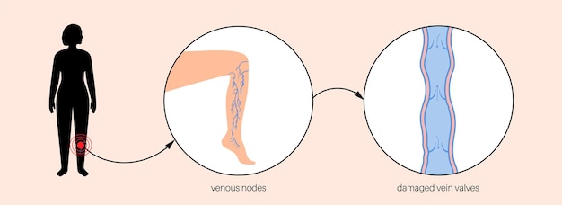 Vector tratamiento de venas varicosas