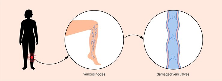 Vector tratamiento de venas varicosas